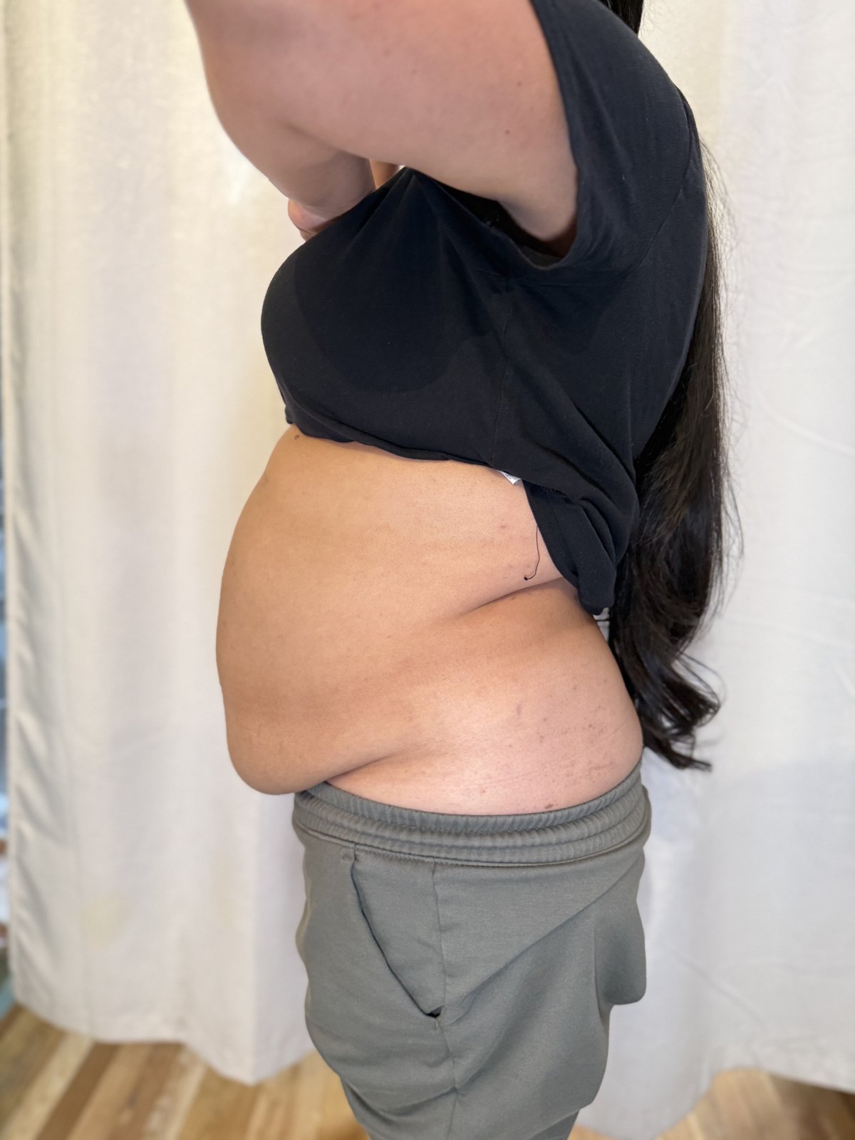 Femme Sculpt before treatment