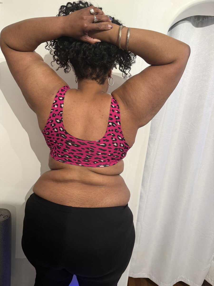 Femme Sculpt after treatment