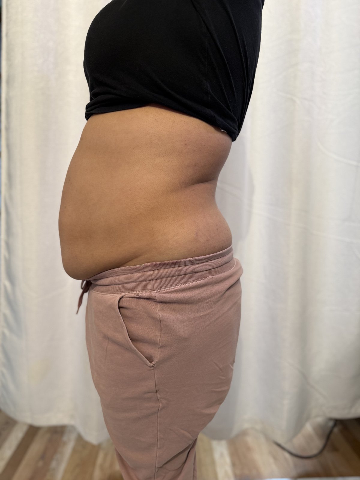 Femme Sculpt after treatment