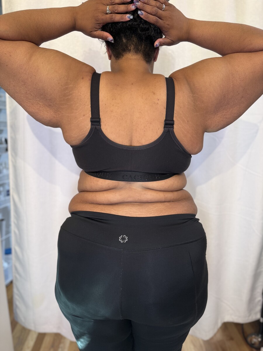 Femme Sculpt before treatment